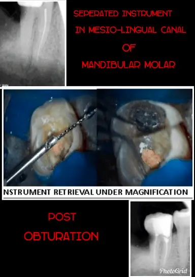 Retrieval of Separated Instruments from the Root CanalUnder Dom