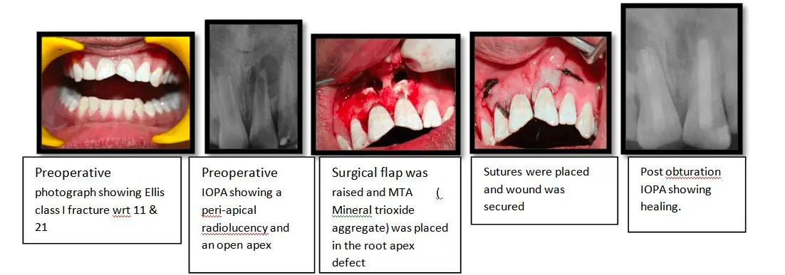 Apicoectomy