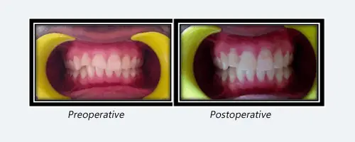 Composite Veenering