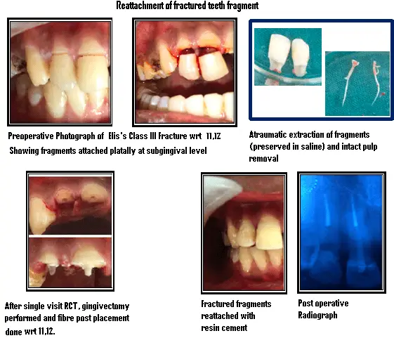 Fragment Reattachment After Traumatic Injury