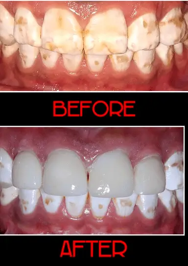 Management of Discoloured Teeth with Veneers