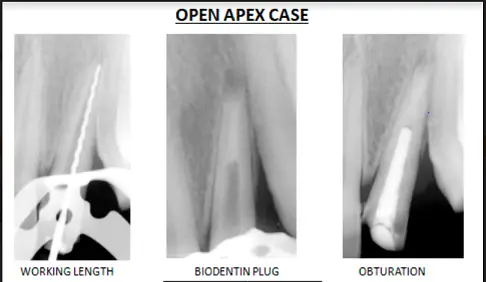 Management of Open Apex Under Dental
                            Operating Microscope