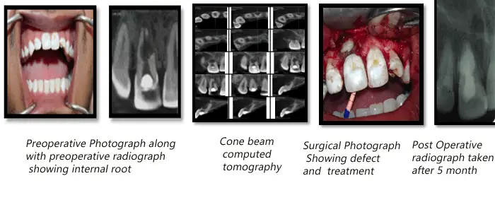 Perforating Internal Resorption