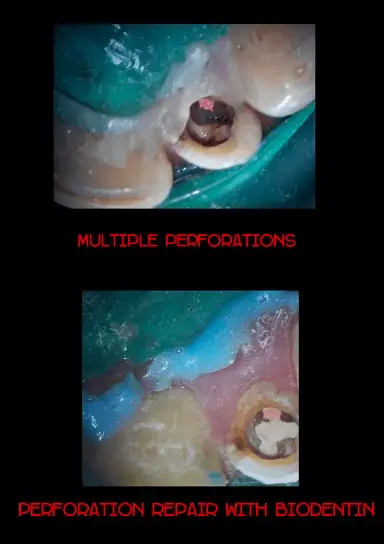 Perforation Repair Under Dental Operating 
                            Microscope